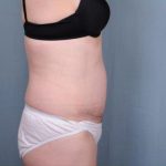 Abdominoplasty Before & After Patient #1905