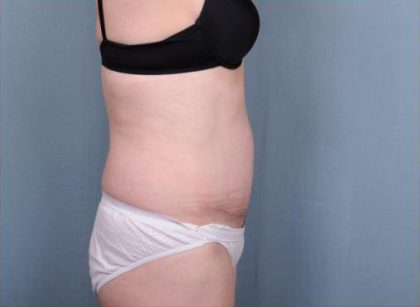 Abdominoplasty Before & After Patient #1905