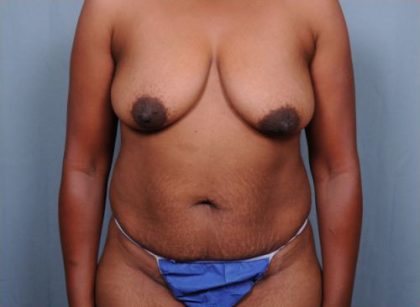 Abdominoplasty Before & After Patient #1904