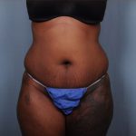 Abdominoplasty Before & After Patient #1903