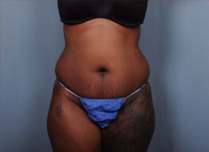 Abdominoplasty Before & After Patient #1903