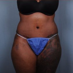 Abdominoplasty Before & After Patient #1903