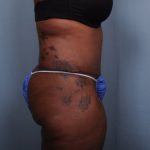 Abdominoplasty Before & After Patient #1903