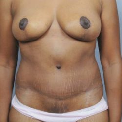 Abdominoplasty Before & After Patient #1904