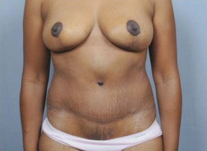 Abdominoplasty Before & After Patient #1904