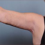 Brachioplasty Before & After Patient #1551