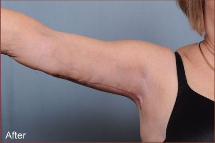 Brachioplasty Before & After Patient #1551