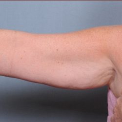 Brachioplasty Before & After Patient #1551