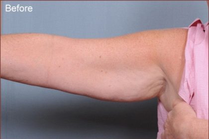 Brachioplasty Before & After Patient #1548