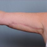 Brachioplasty Before & After Patient #1548