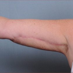 Brachioplasty Before & After Patient #1548