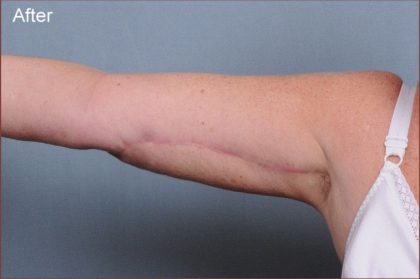 Brachioplasty Before & After Patient #1548