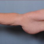 Brachioplasty Before & After Patient #1549