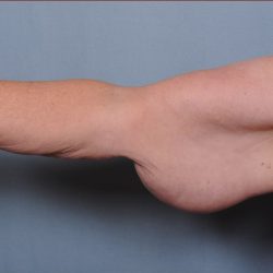 Brachioplasty Before & After Patient #1549
