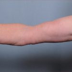 Brachioplasty Before & After Patient #1549
