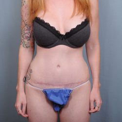 Abdominoplasty Before & After Patient #1545