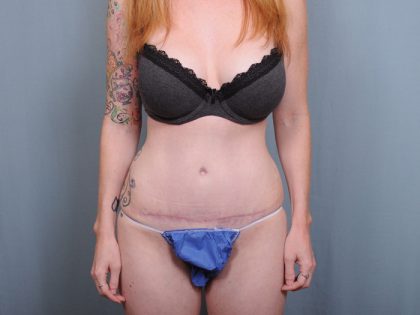 Abdominoplasty Before & After Patient #1545