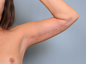 Brachioplasty Before & After Patient #1552