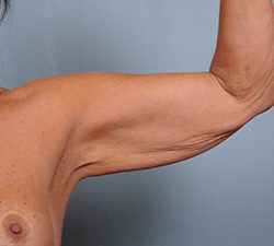 Brachioplasty Before & After Patient #1552