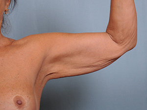 Brachioplasty Before & After Patient #1552