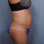 Abdominoplasty Before & After Patient #1637