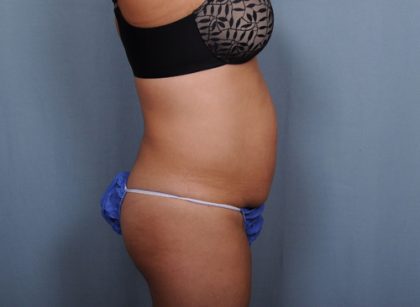 Abdominoplasty Before & After Patient #1637