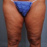 Thigh Lift Before & After Patient #1632