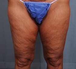 Thigh Lift Before & After Patient #1632