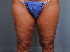 Thigh Lift Before & After Patient #1632