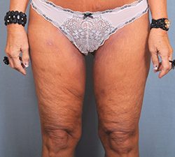 Thigh Lift Before & After Patient #1632