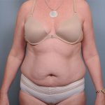 Abdominoplasty Before & After Patient #1631