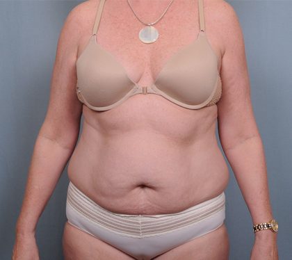 Abdominoplasty Before & After Patient #1631