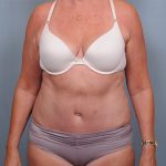 Abdominoplasty Before & After Patient #1631