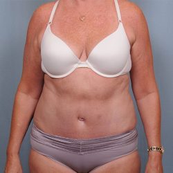 Abdominoplasty Before & After Patient #1631
