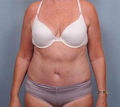 Abdominoplasty Before & After Patient #1631