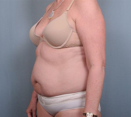 Abdominoplasty Before & After Patient #1631