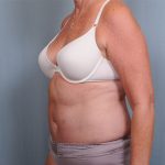 Abdominoplasty Before & After Patient #1631
