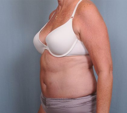 Abdominoplasty Before & After Patient #1631