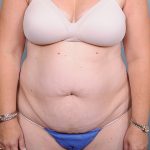 Abdominoplasty Before & After Patient #1629