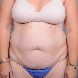 Abdominoplasty Before & After Patient #1629