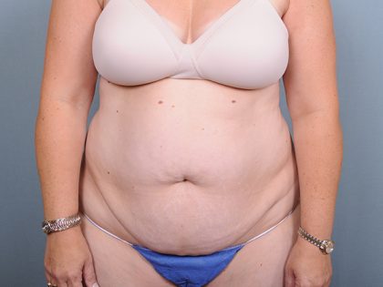 Abdominoplasty Before & After Patient #1629