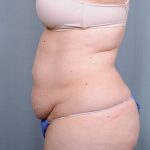 Abdominoplasty Before & After Patient #1629