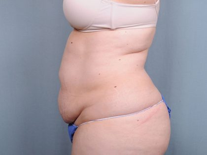 Abdominoplasty Before & After Patient #1629