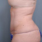 Abdominoplasty Before & After Patient #1629