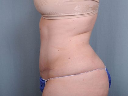 Abdominoplasty Before & After Patient #1629