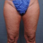 Thigh Lift Before & After Patient #1838