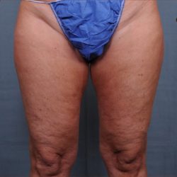 Thigh Lift Before & After Patient #1838