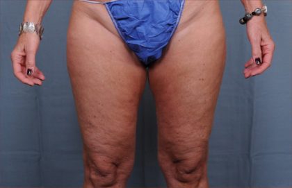 Thigh Lift Before & After Patient #1838