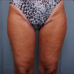 Thigh Lift Before & After Patient #1838