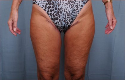 Thigh Lift Before & After Patient #1838